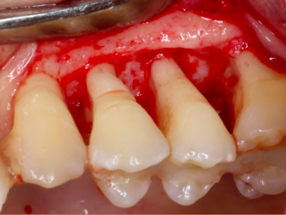 歯肉剥離搔爬術（歯周外科）
